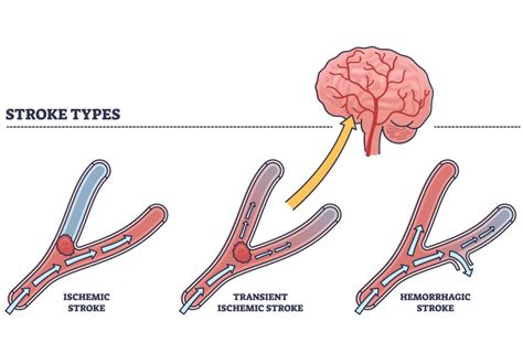 Transient ischemic attack (TIA)